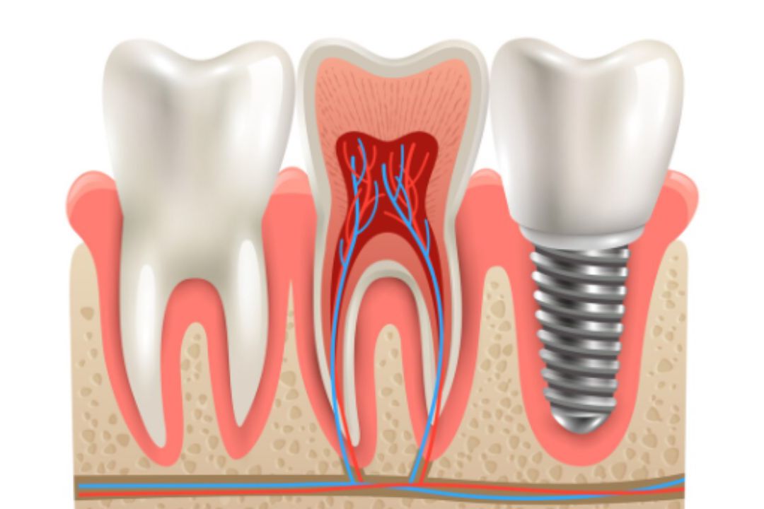 zygomatic implants cost in mumbai  affordable prices in mumbai